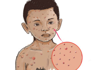 19 children feared killed by measles in Adamawa